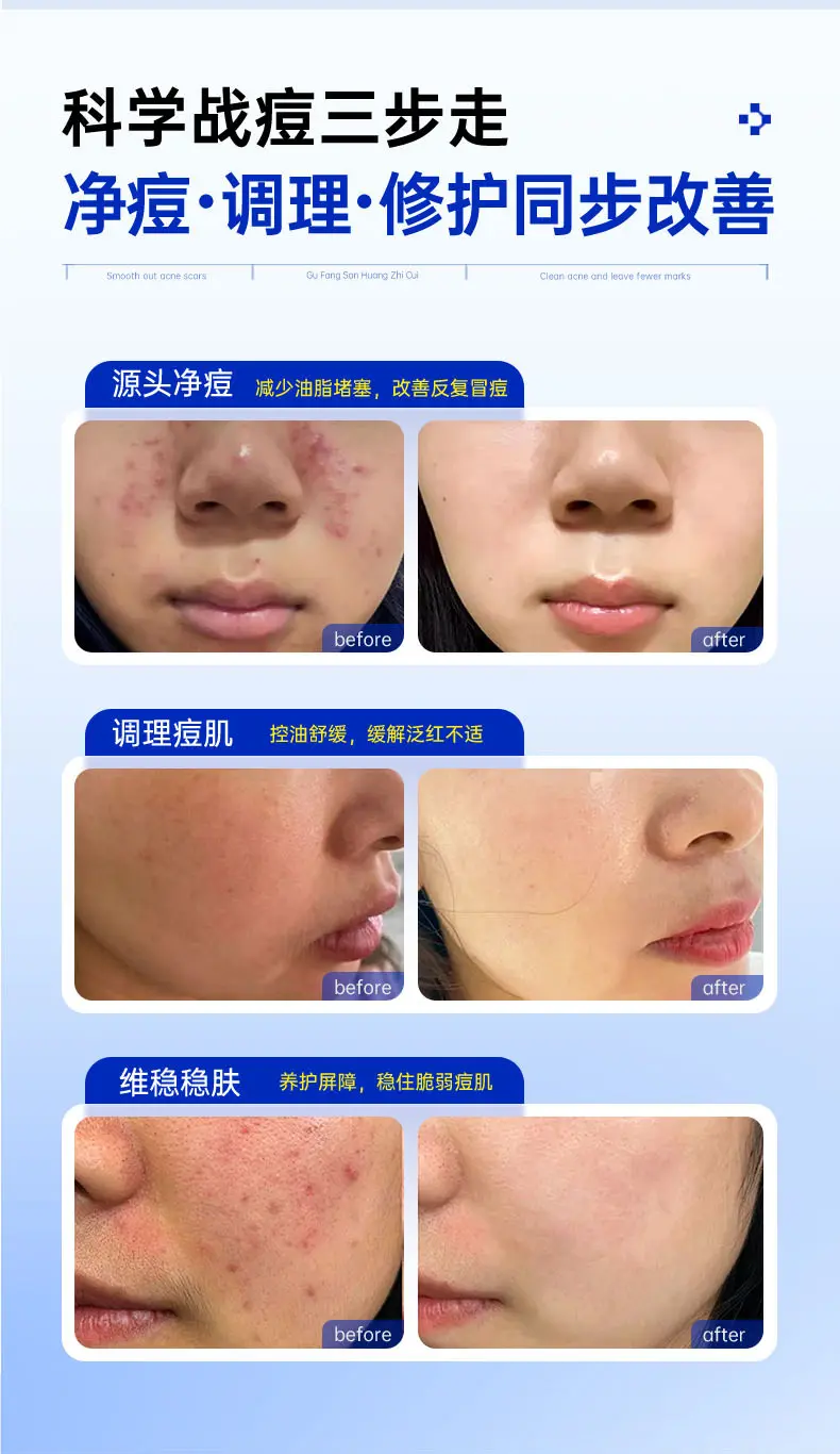 JunXian Blue Bottle Acne Serum II