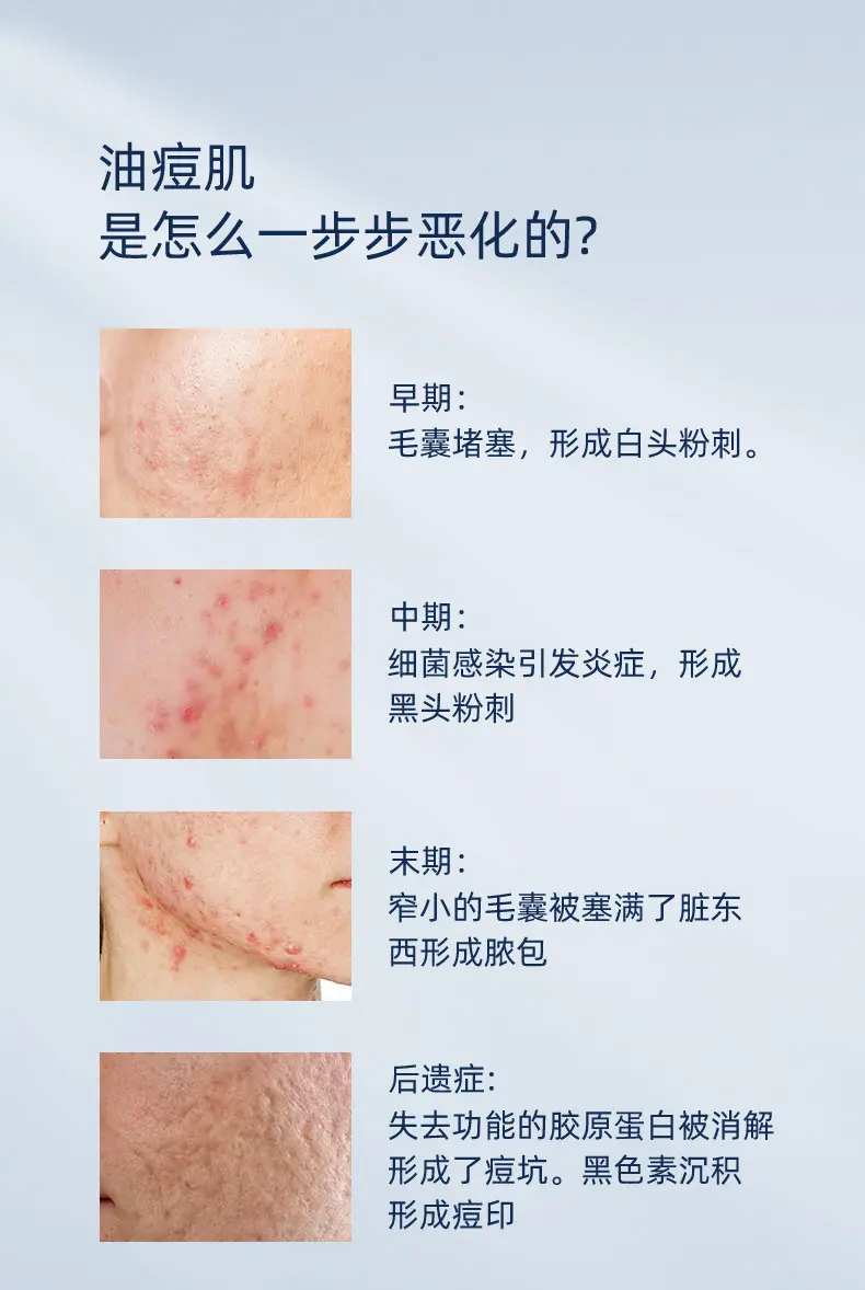 JunXian Clear Acne Relief Toner
