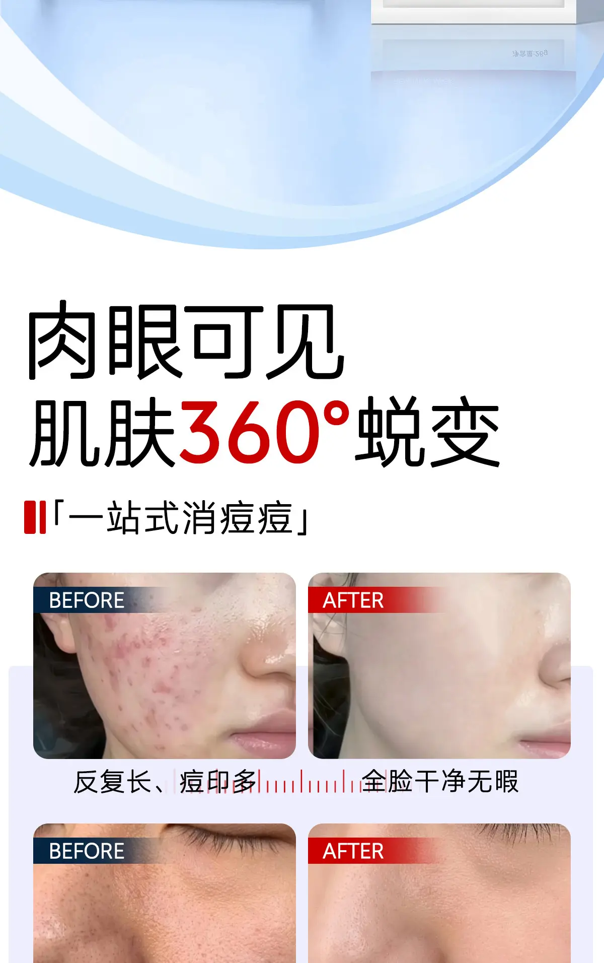 JunXian Clear Acne Mask